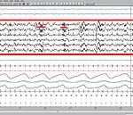 EEG Phase 2 (image Wikipédia)