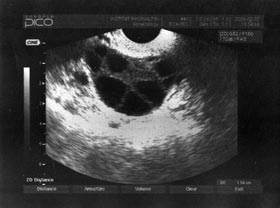 Ovaire après 25 jours de stimulation Source : Institut Rhône Alpin pour la reproduction humaine.