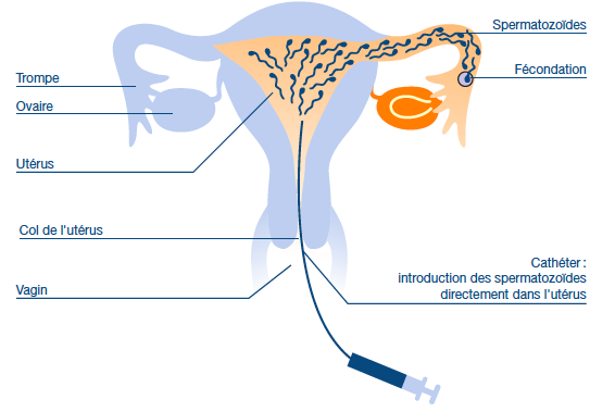 Schéma d'une insémination artificielle Source : Centre de PMA de Lausanne, www.cpma.ch