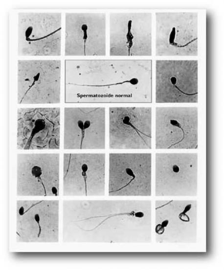 Spermatozoïdes normaux et malformés