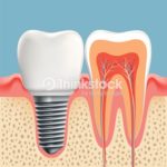 ps385_Implant.jpg